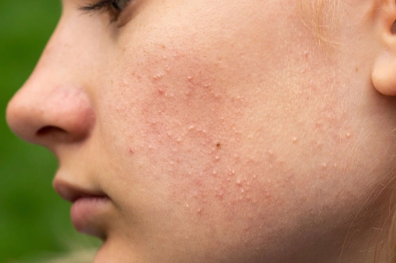 Bumps After Waxing? Here’s How to Keep Your Skin Smooth and Clear
